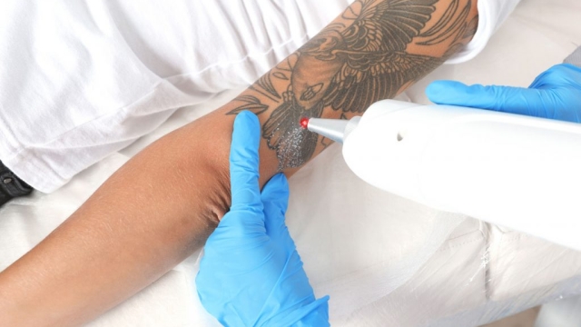 Choices Get Rid Of Tattoos Belonging To The Body