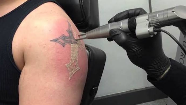 Selecting A Tattoo Removal Laser Clinic