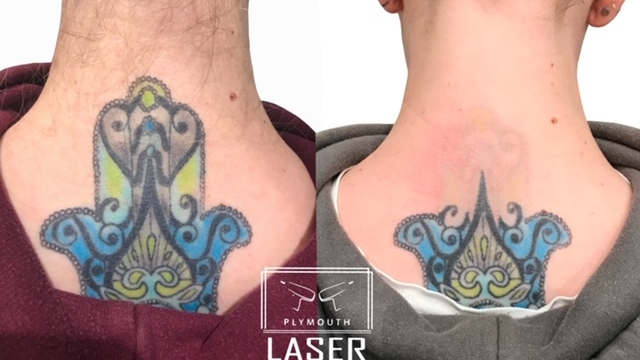 Tattoo Removal Made Easy With Anti Aging Laser Treatment