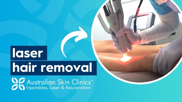Goodbye Razors: Embrace Smooth Skin with Laser Hair Removal